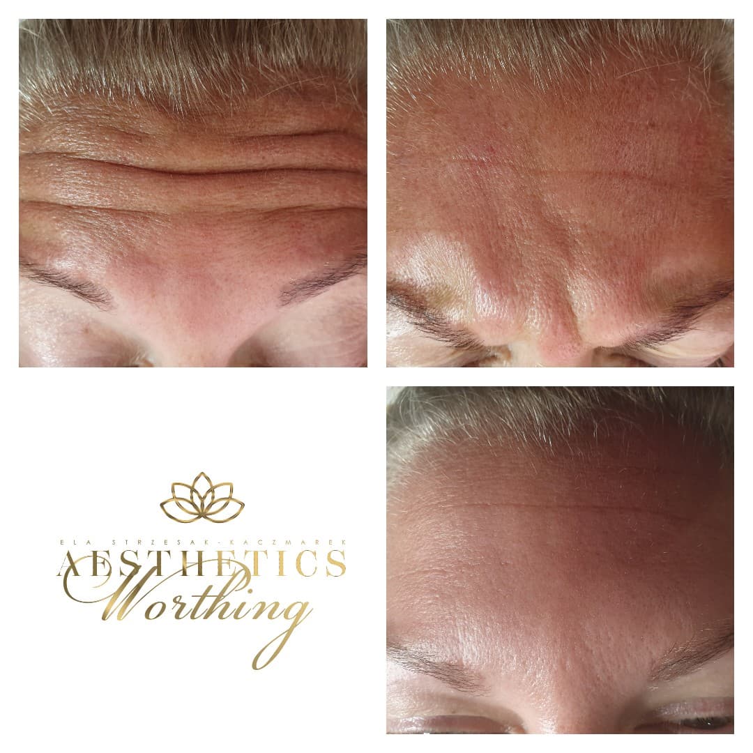 Before and after forehead lines, Aesthetics Worthing
