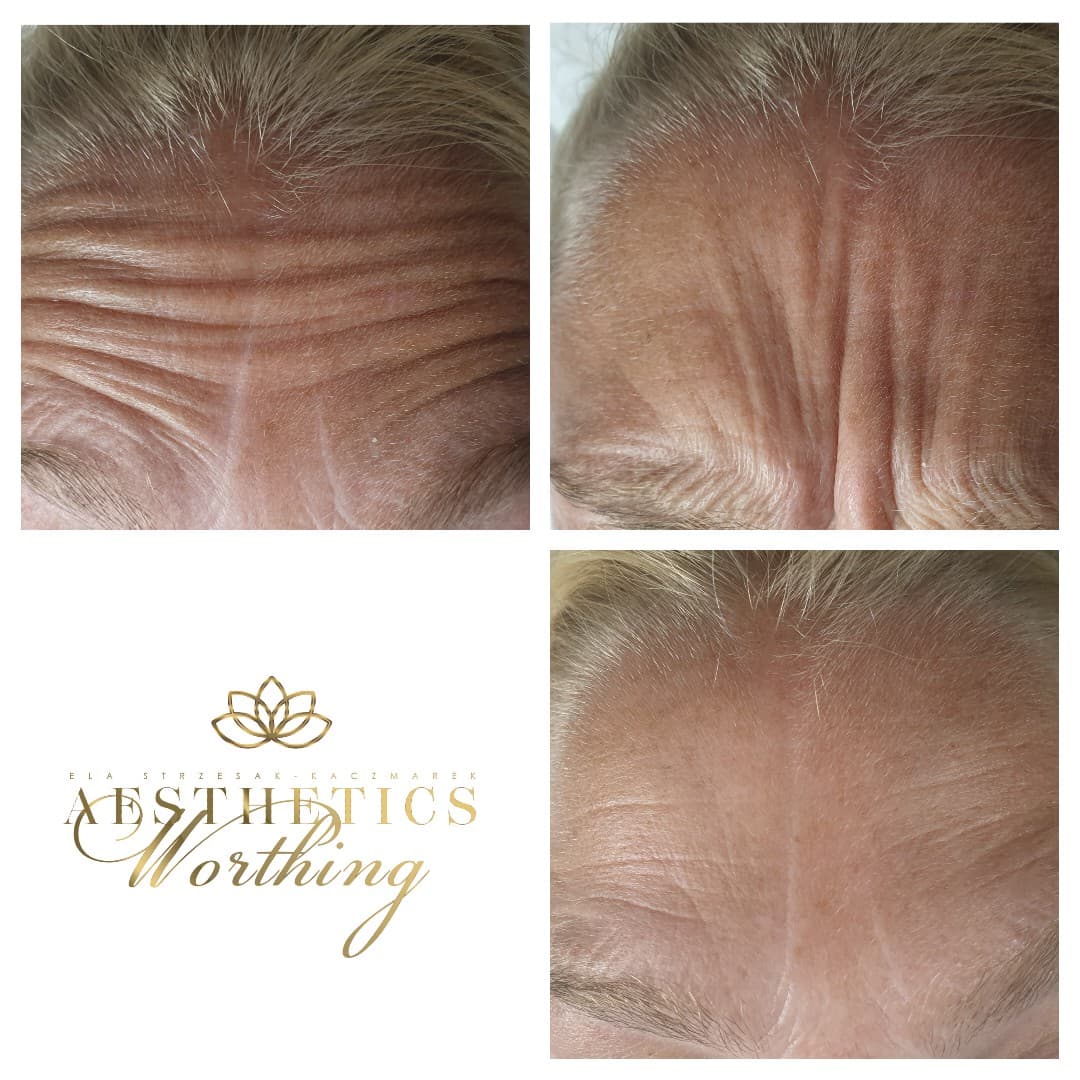Before and after frown and forehead lines