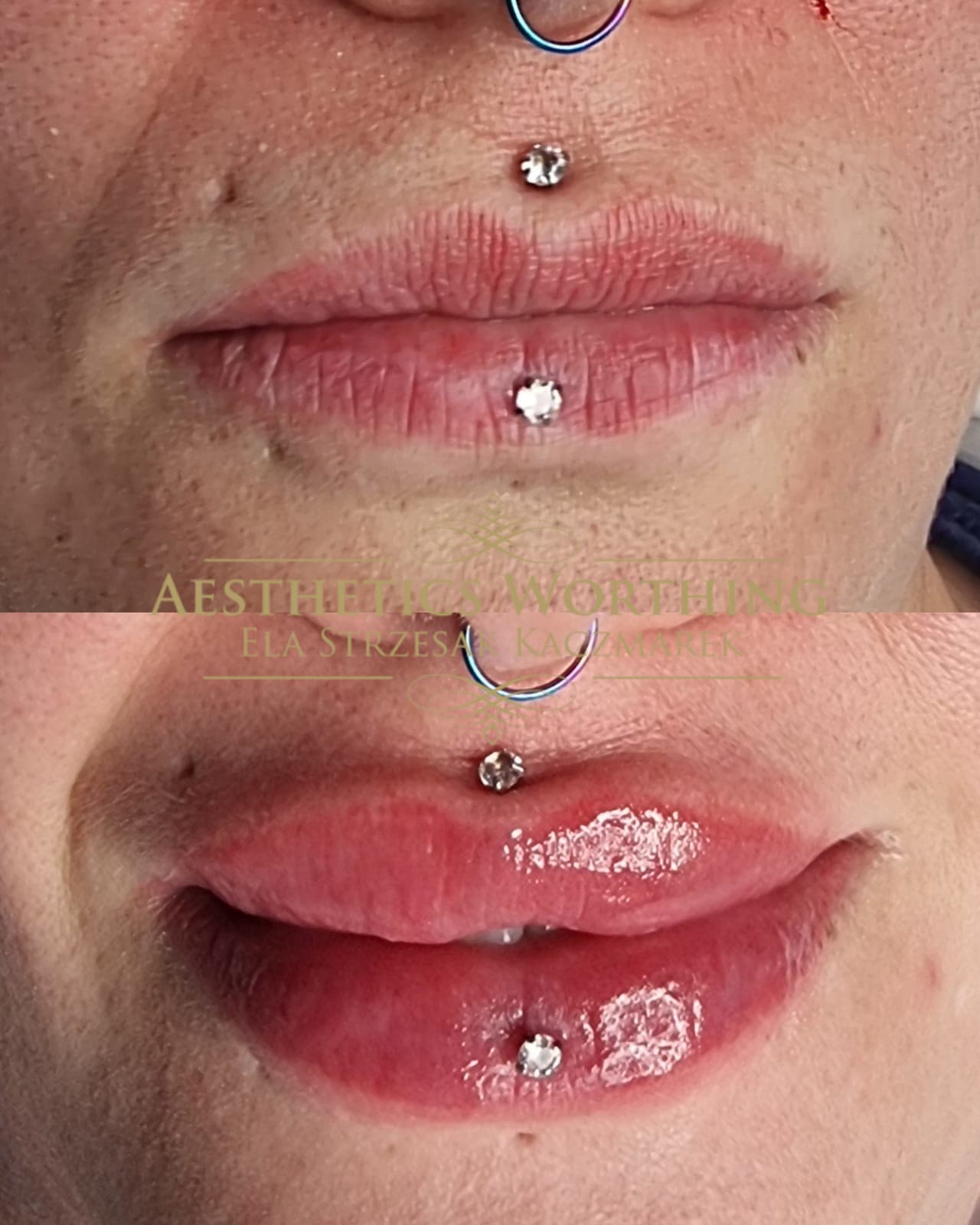Before and after lip filler