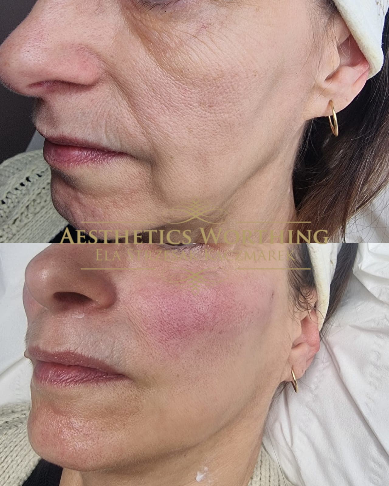 Before and after cheek and jaw skin treatment