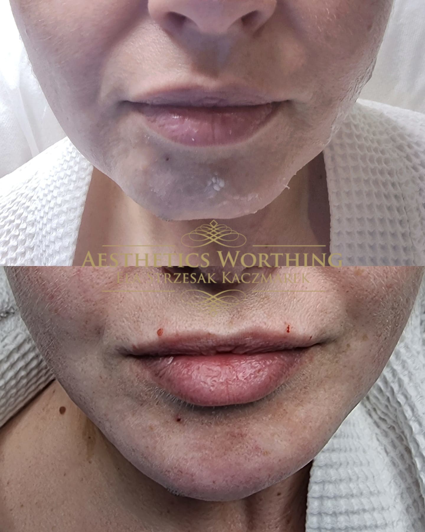 Before and after lip enhancement