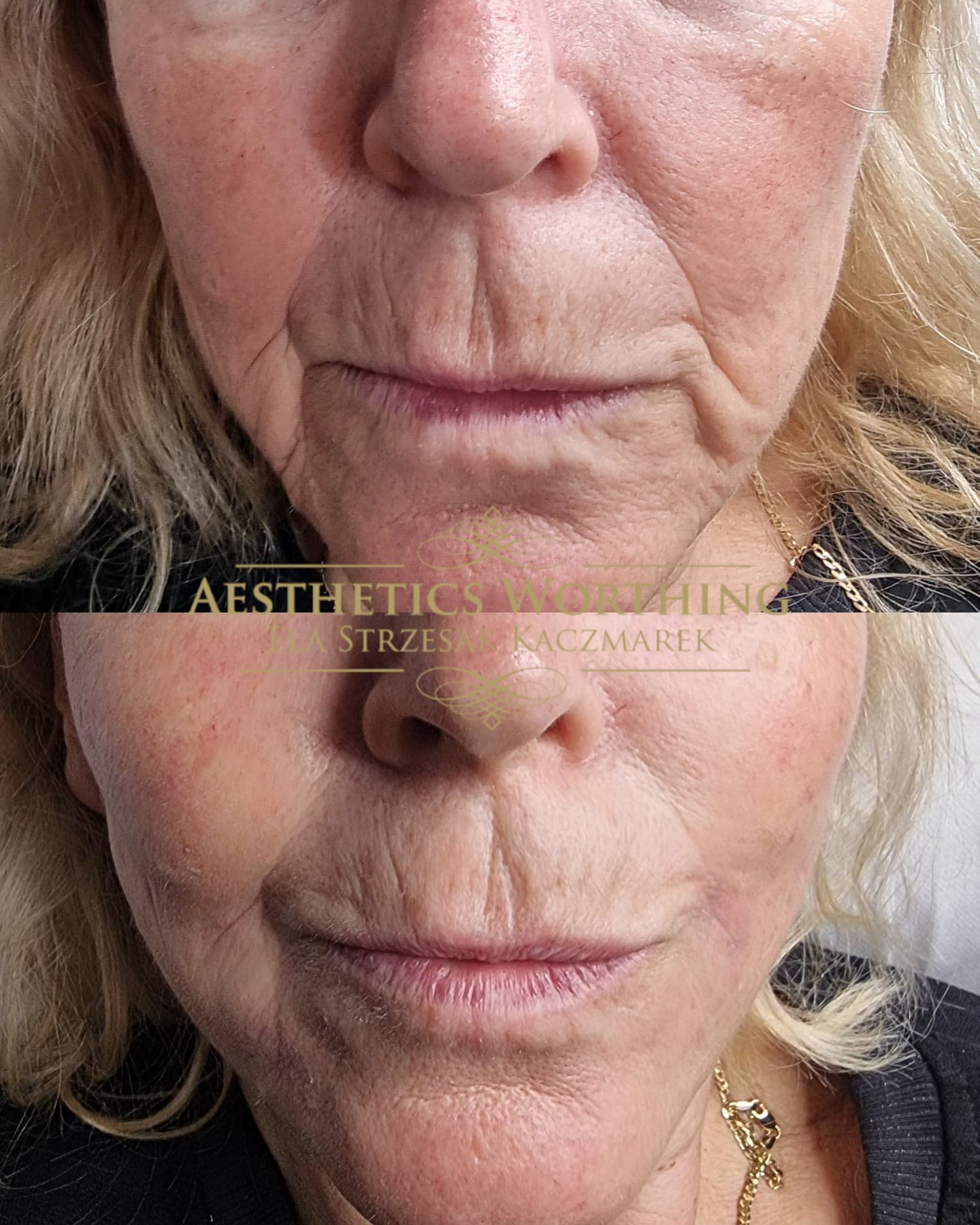 Before and after treatment around the mouth