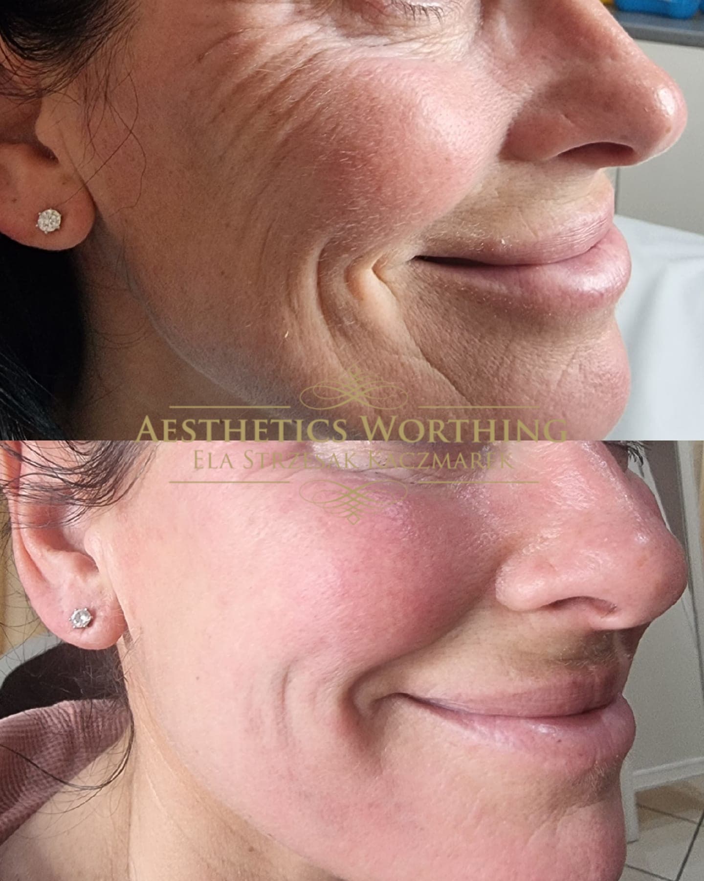 Before and after lines around the eye and mouth