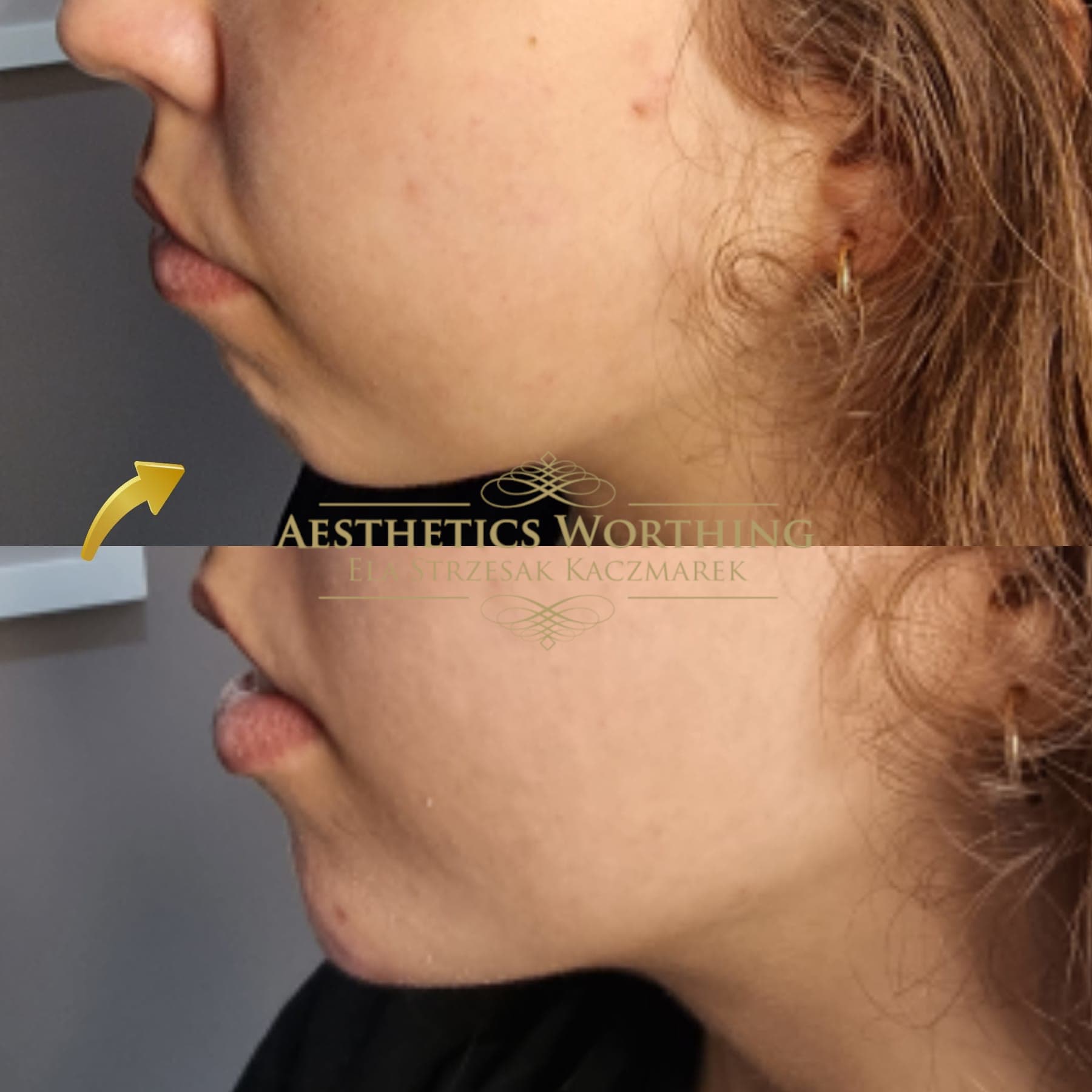 Before and after chin profile