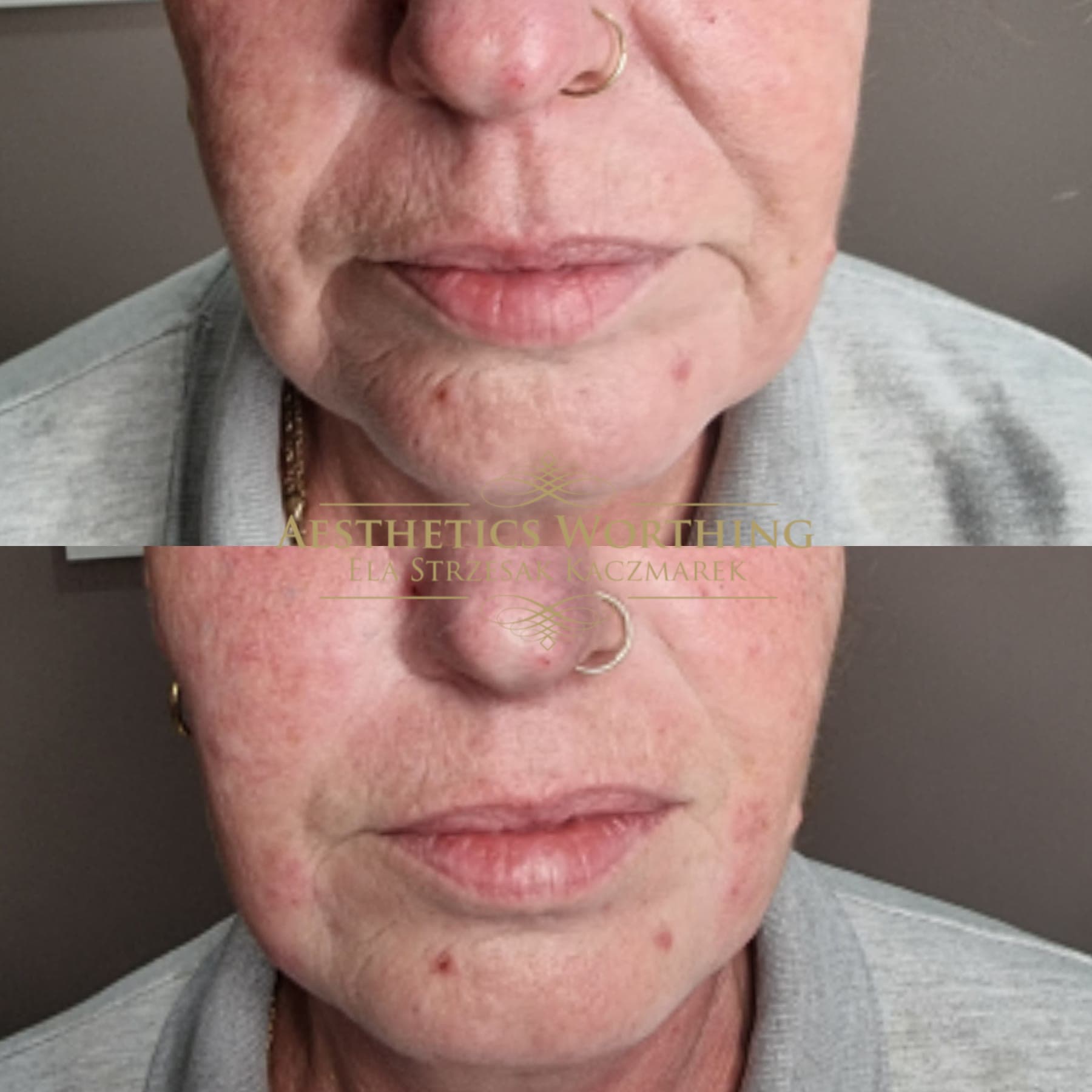 Before and after lower-face lines