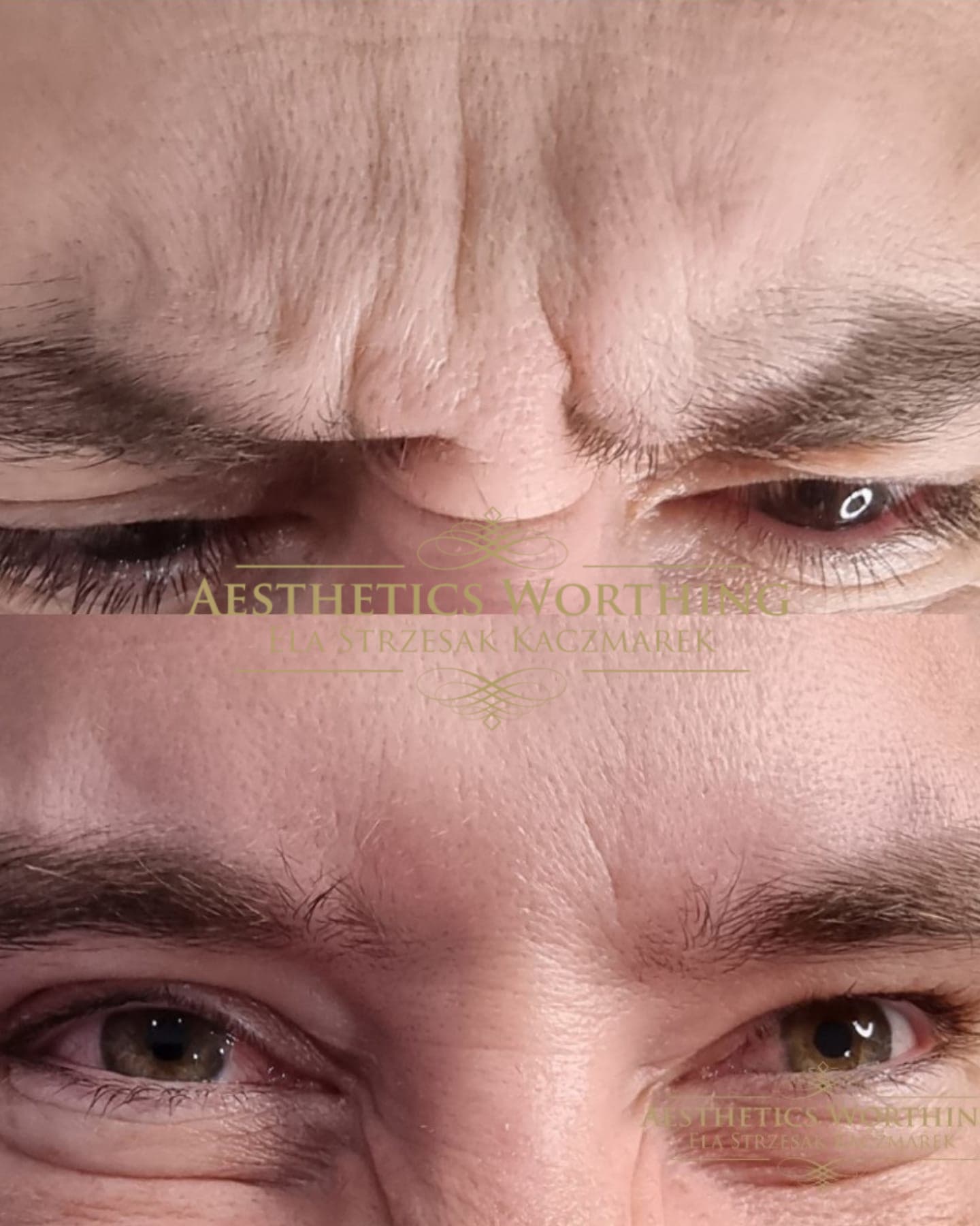 Before and after frown lines