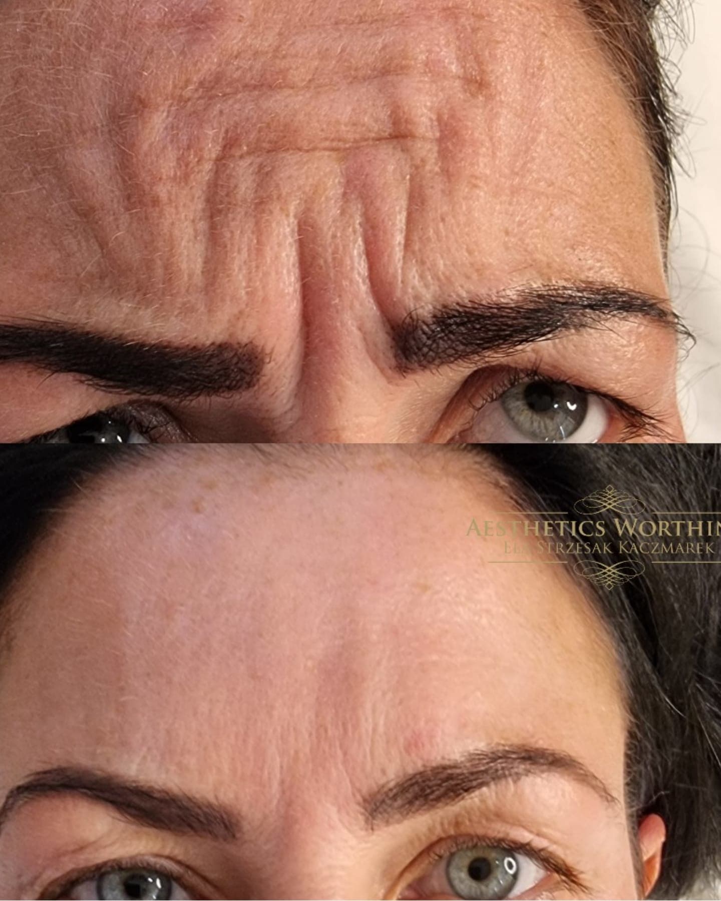 Before and after forehead lines