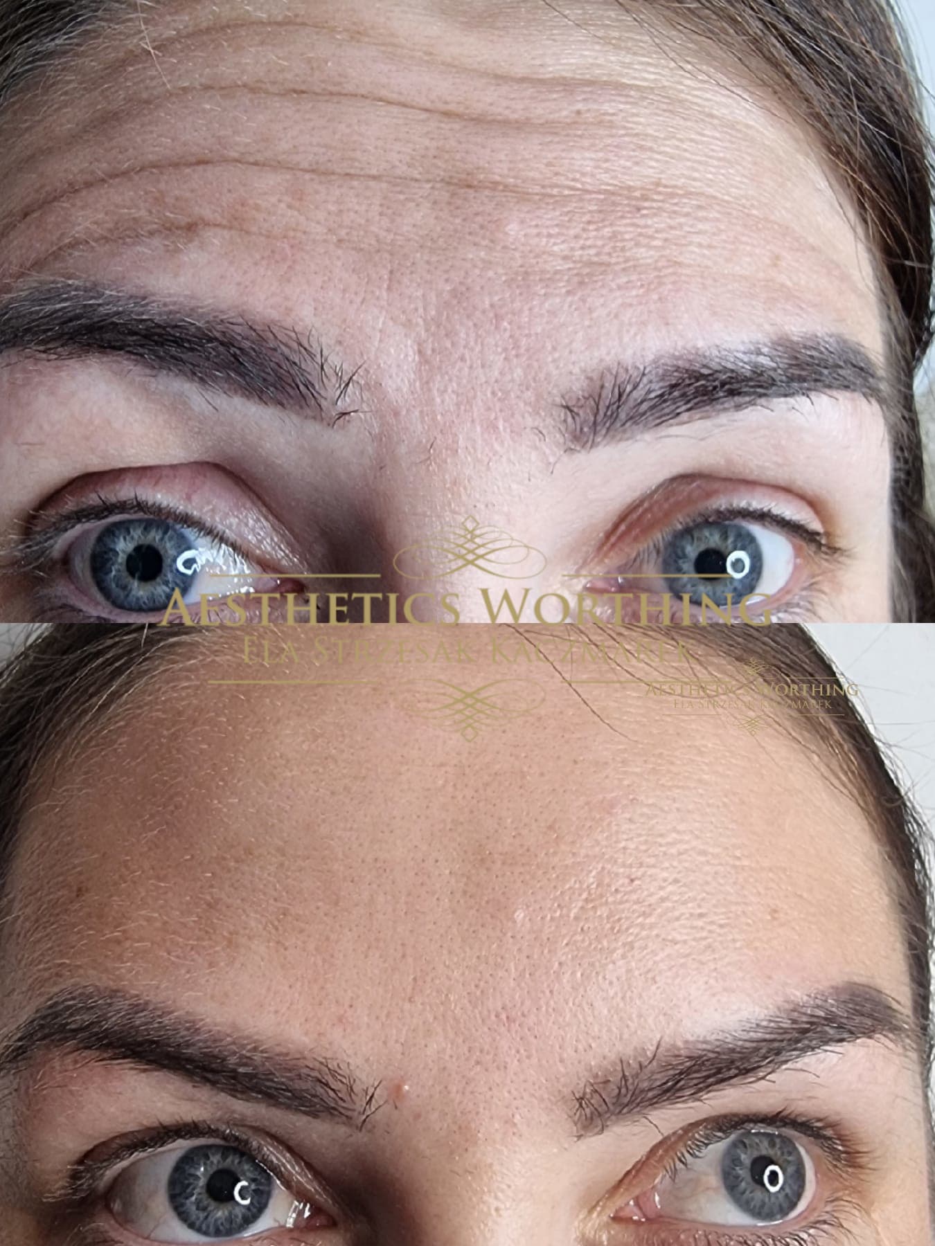 Before and after forehead treatment