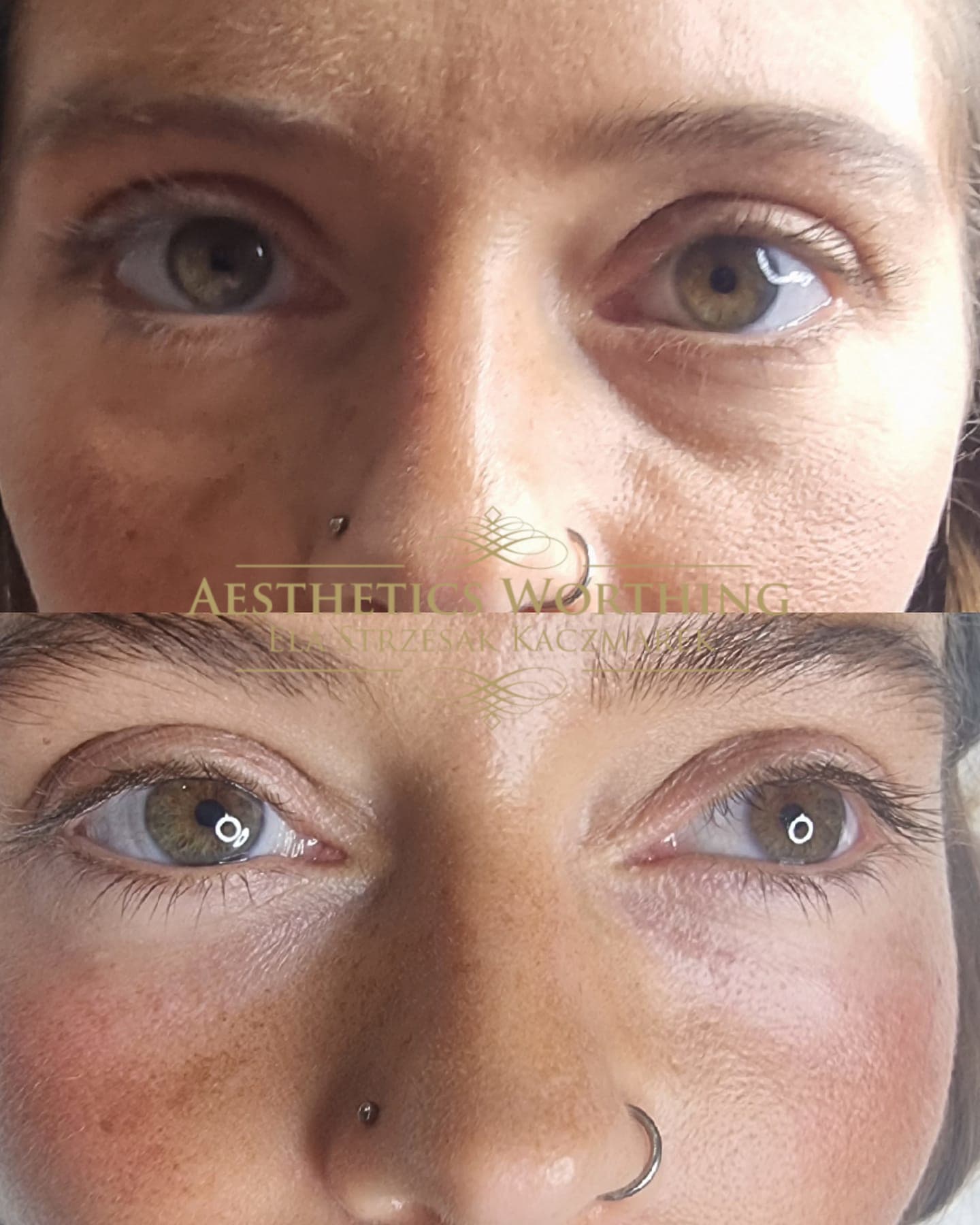 Before and after under-eye and cheek complexion