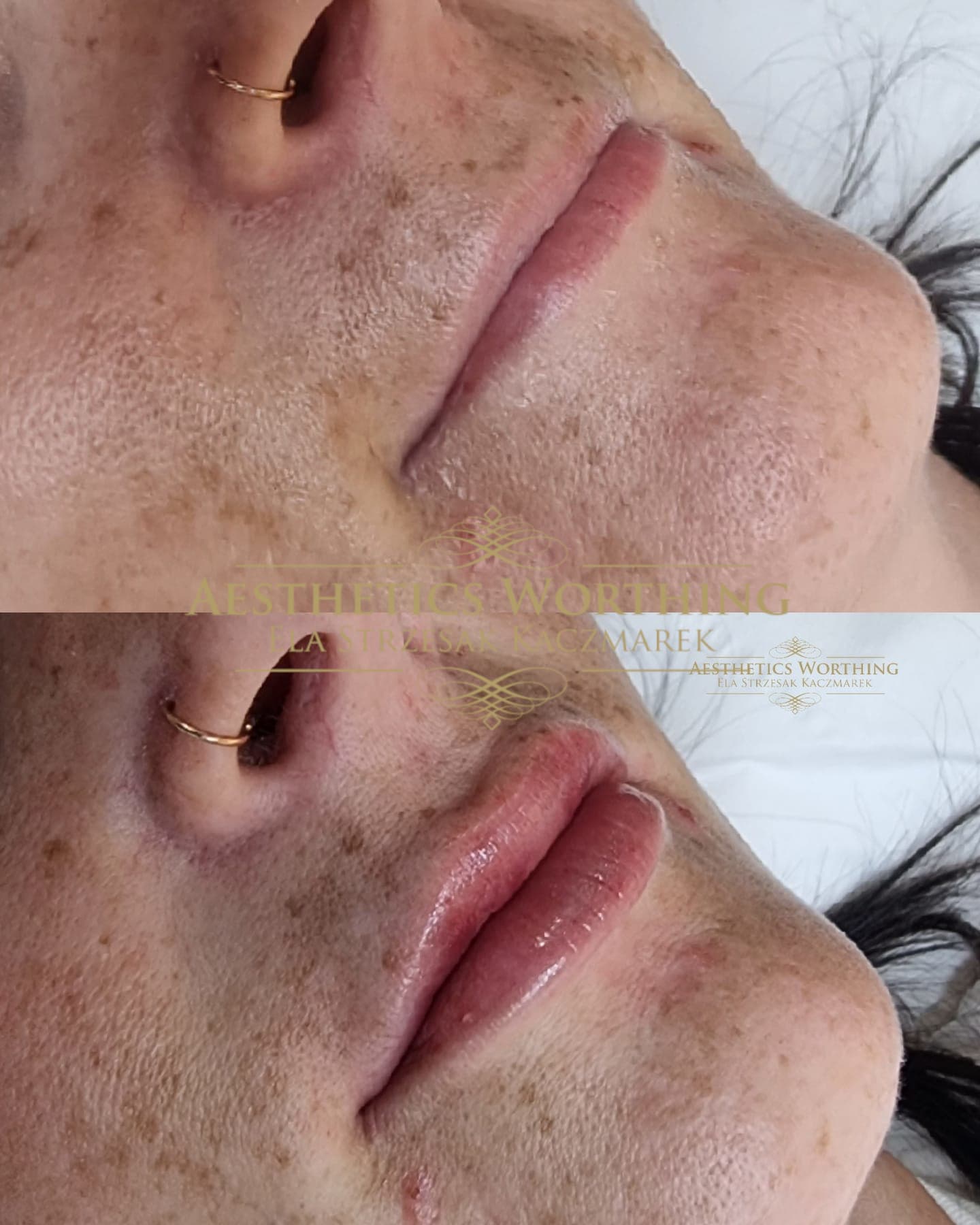 Before and after lip volume