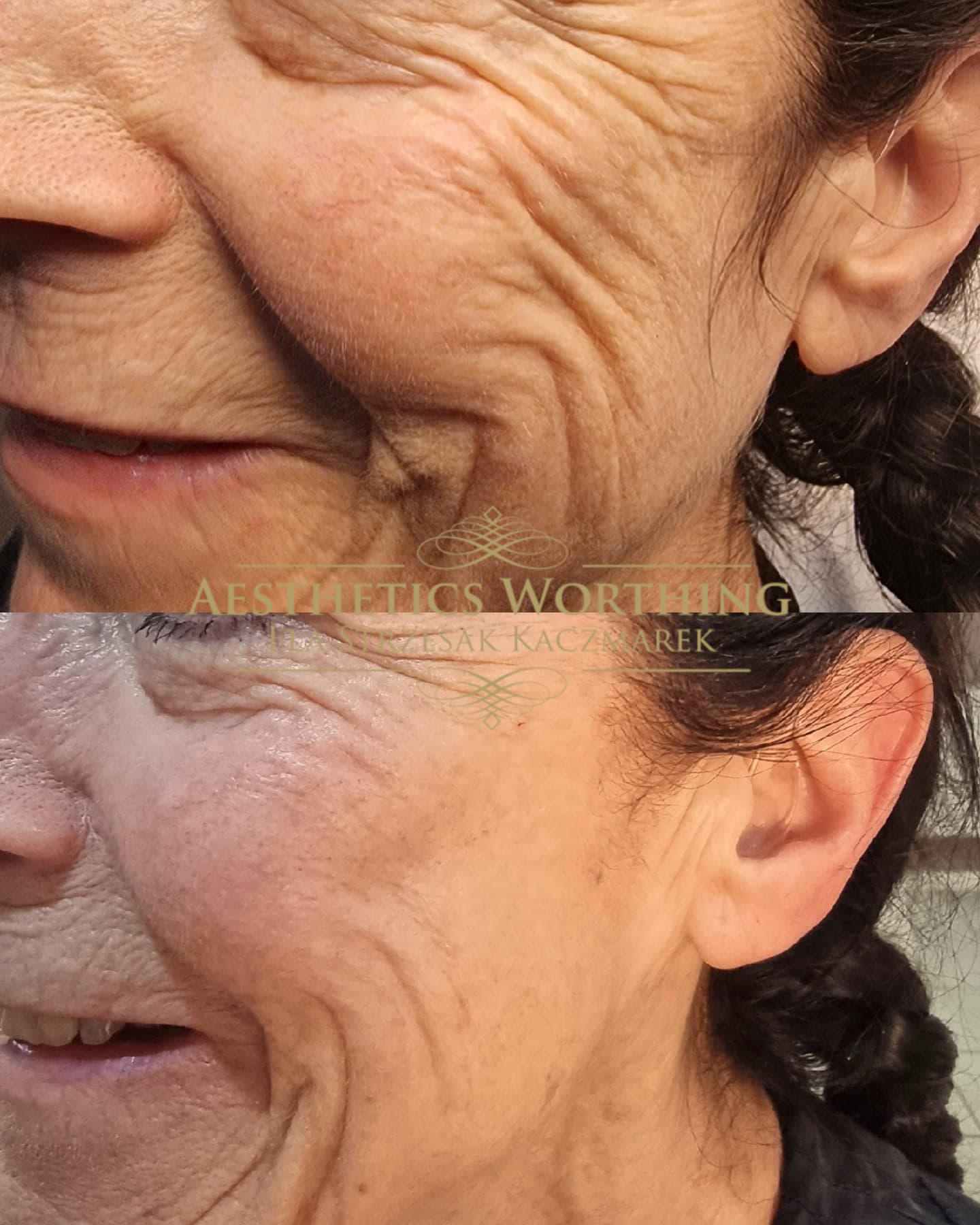 Before and after cheek and smile lines