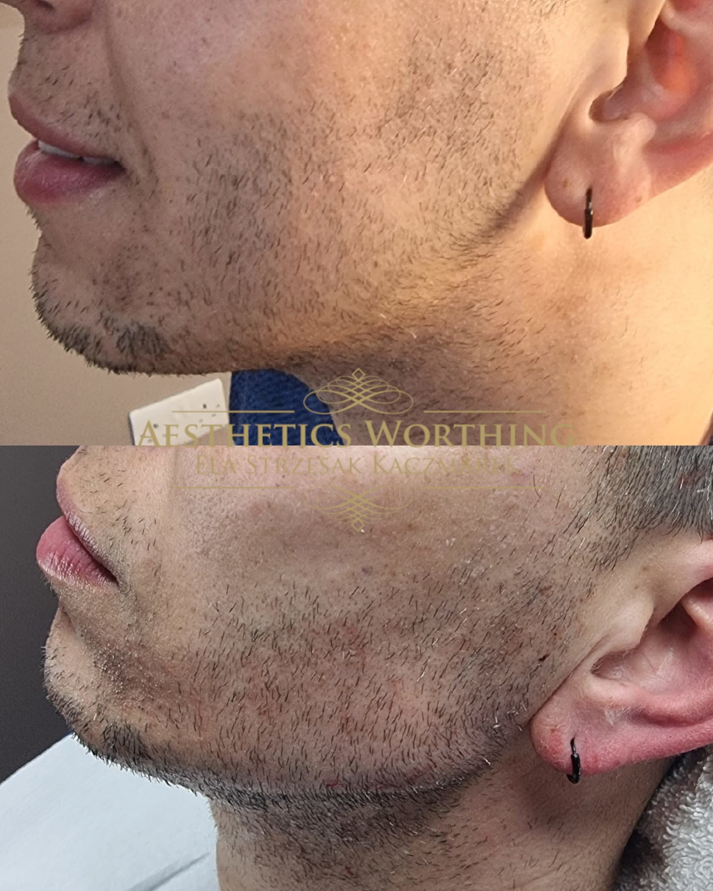 Before and after jawline definition
