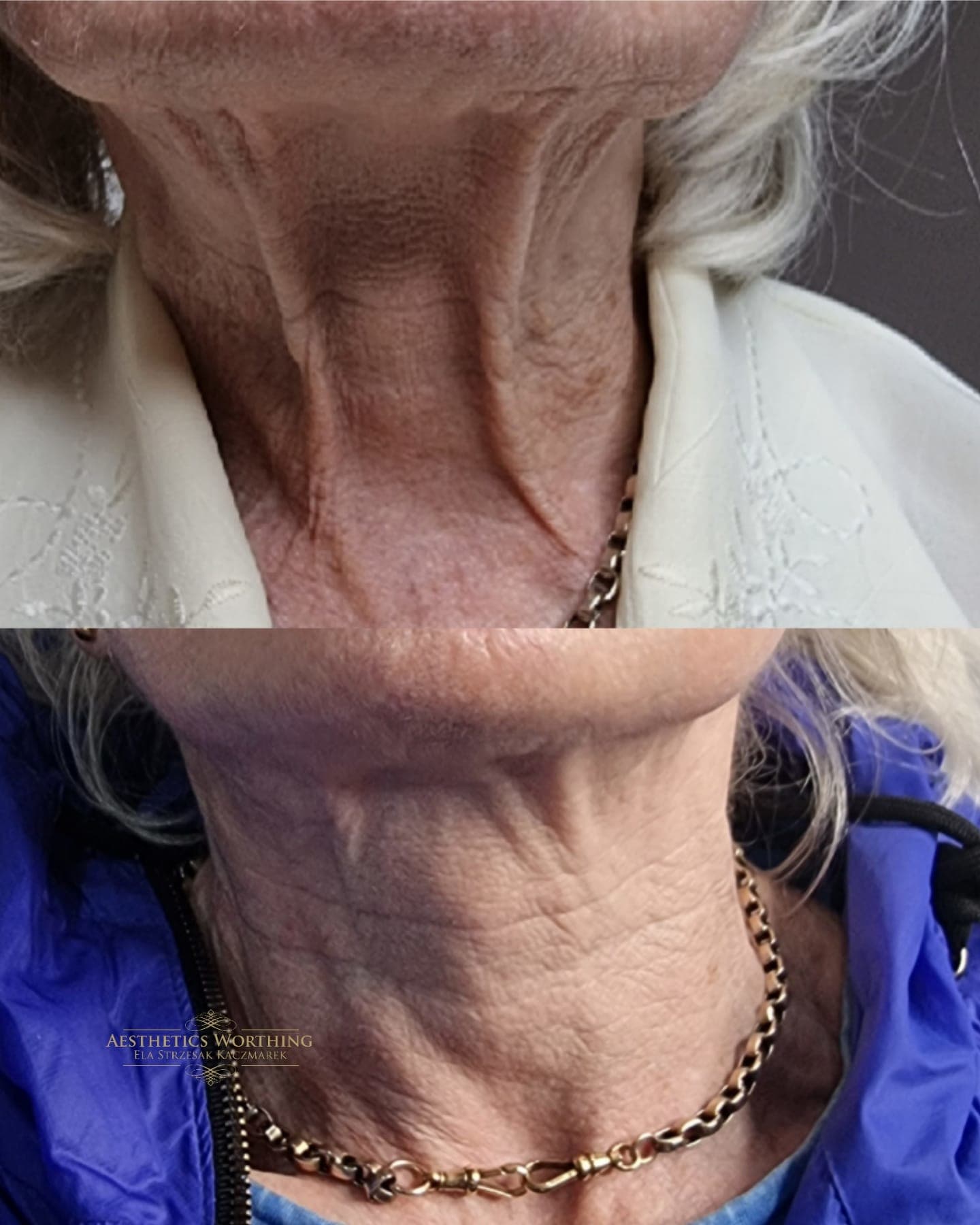 Before and after treatment for neck bands