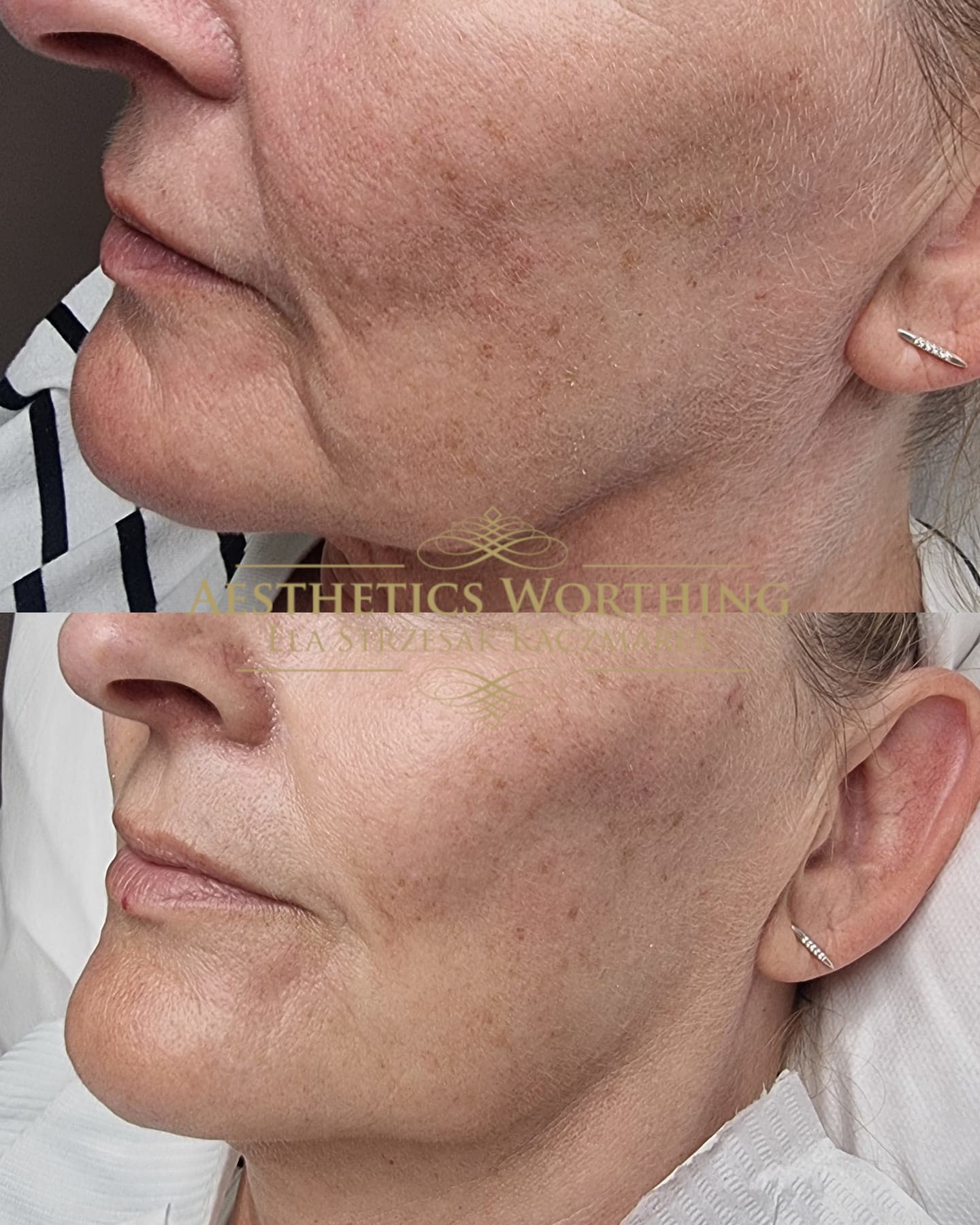 Before and after jawline and skin quality