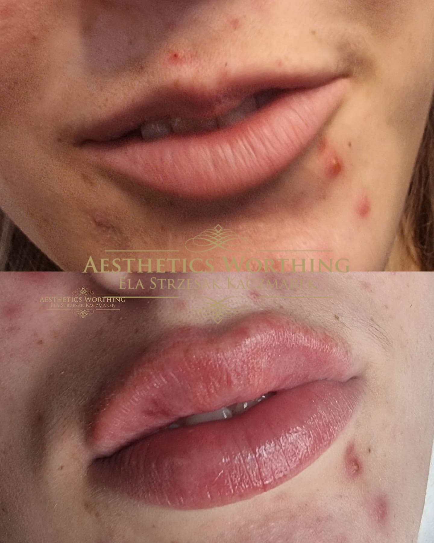 Before and after lip definition