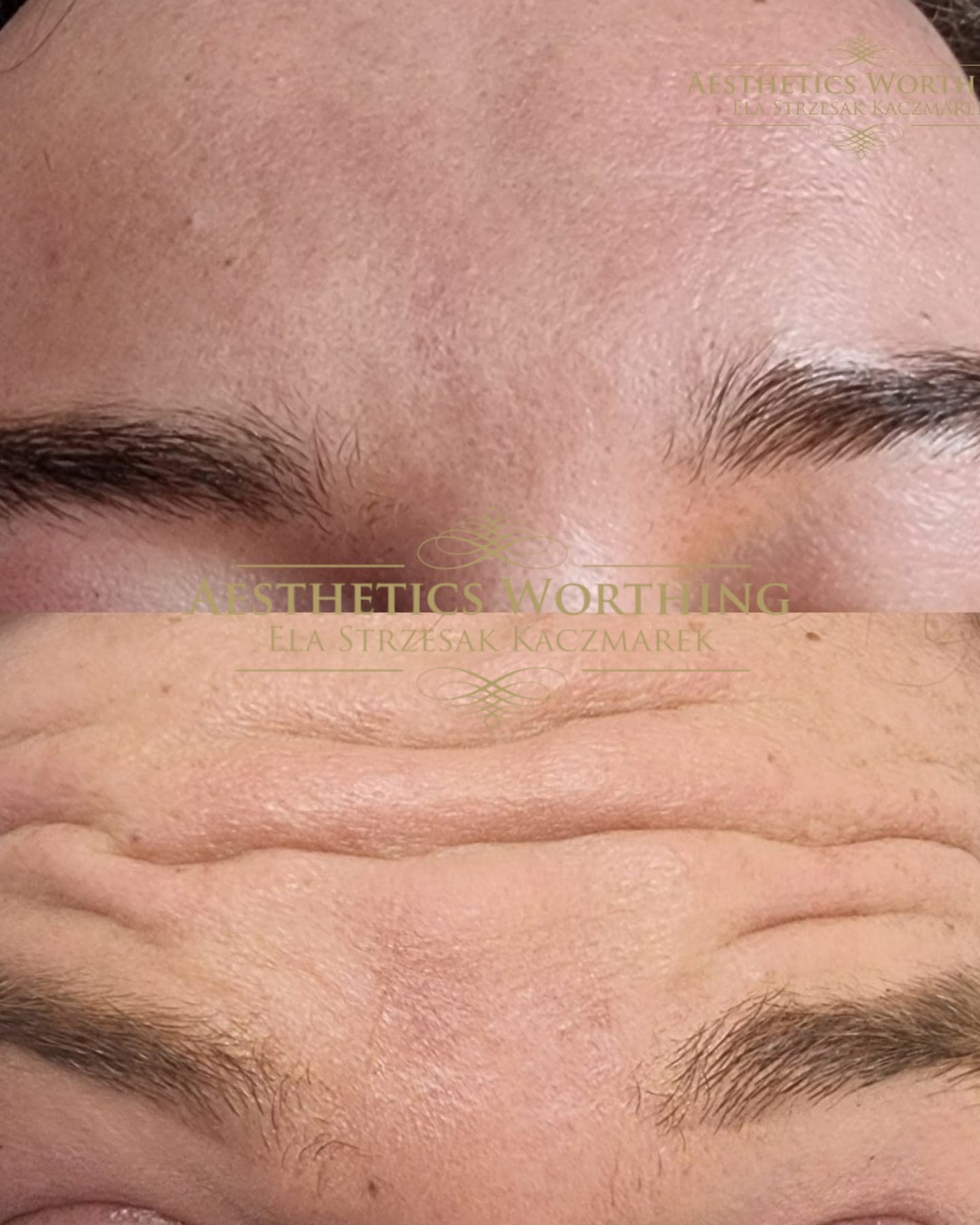 Before and after forehead movement lines