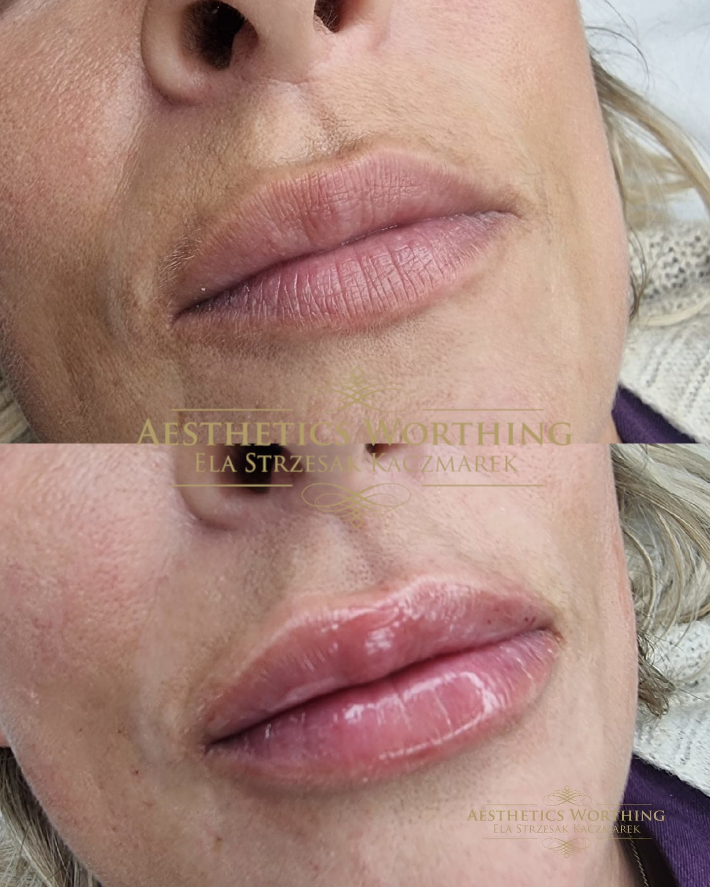 Before and after lip filler treatment
