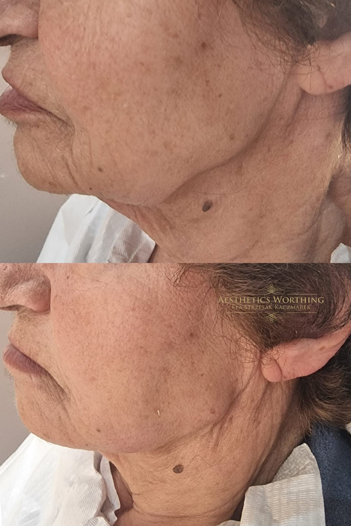 Before and after jawline and neck profile